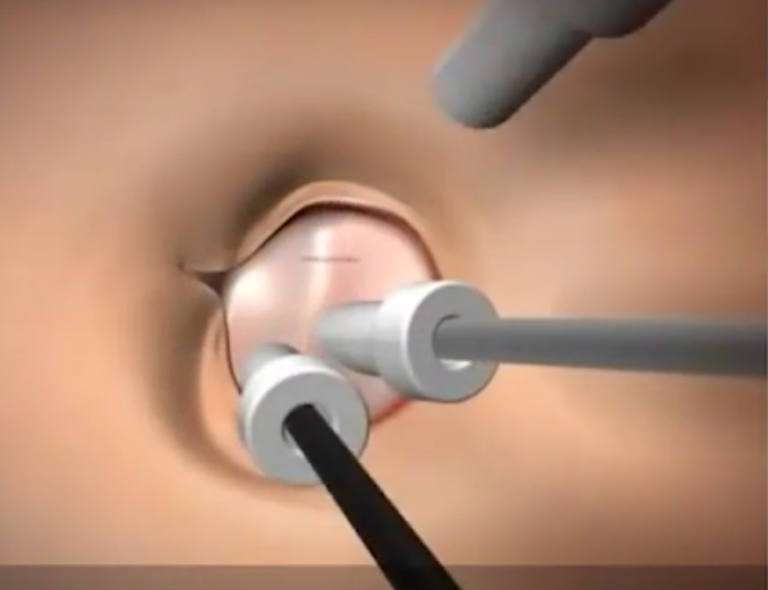 Λιθίαση Χοληδόχου Κύστης: Τι πρέπει να Γνωρίζουμε